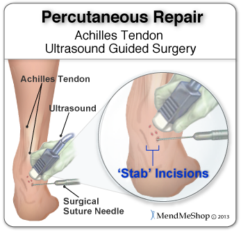 Skilled surgeons may perform a percutaneous achilles tendon surgery with ultrasound imaging techniques to allow for blink suturing with stab incisions made by a surgical suture needle.