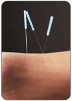A PT may use acupuncture to relax your Achilles tendon after stretching