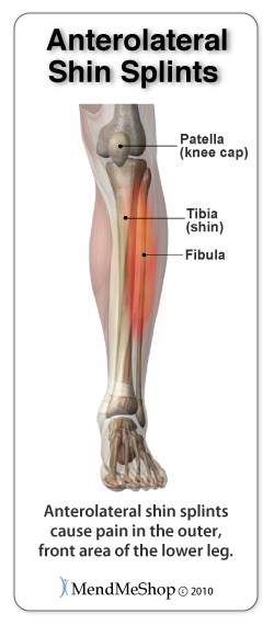 Anterolateral Shin Splint pain occurs in the outer front of lower leg