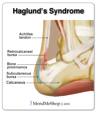 Haglund's Syndrome - inflammation in the Achilles tendon and retrocalcaneal bursa.