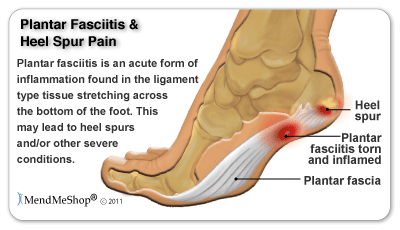 Plantar fasciitis inflammation and pain occurs at the bottom of the foot and close to the heel (calcaneus)
