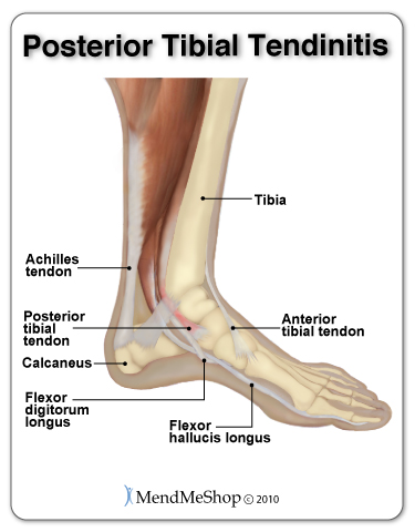 Tiny tears and inflammation in the posterior tibial tendon leads to tendinitis and pain in the arch of the foot.