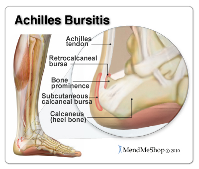 Heel clearance bursa treatment