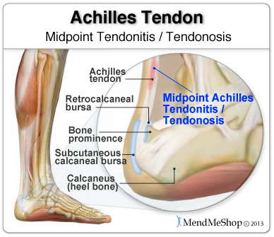 quick relief for achilles tendonitis