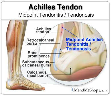 achilles tendon attachment pain