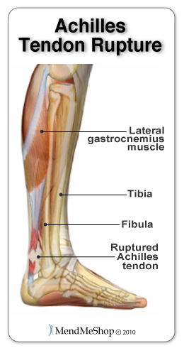 Achilles tendon rupture occurs when the tendon and adjoining muscles are weak.