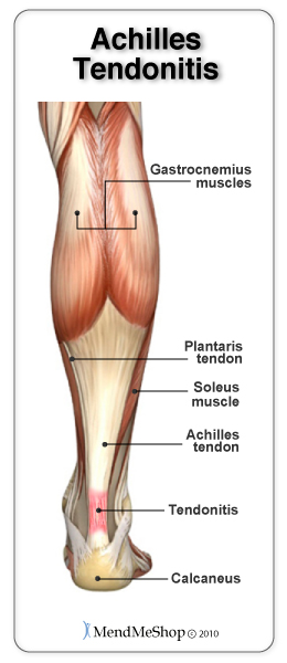 Chronic Achilles tendinitis should never go untreated. It can lead to tendinosis, tenosynovitis or a complete Achilles tendon rupture.