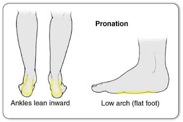 Chronic Achilles tendinitis may be caused by over-pronation of the foot or flat feet.